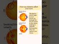 Diabetic Retinopathy | Effects of Diabetes on Eye health