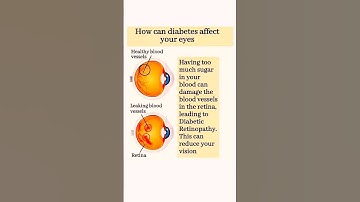 Diabetic Retinopathy | Effects of Diabetes on Eye health