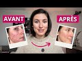 Comment j’ai apaisé mon acné après 10 ans d’échecs (sans pilule ni crème)
