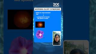 DocTutorials's #QuickLearningByte | Morning Glory Syndrome- Ophthalmology | Dr Shivani Jain