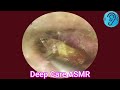 ASMR Ear Cleaning | Guaranteed Tingles and Instant Relaxation