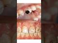 Fluoride as a micronutrient- MN series 5#criticalcaremedicine #neetpg