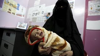 Yemen Unicef Raises Alarm About Child Malnutrition In The Forgotten War