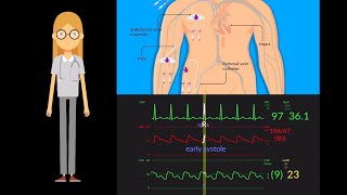 Central Venous Pressure Or Cvp Helps To Ess Fluid Status