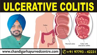 Ulcerative Colitis Ayurvedic Treatment Chandigarh Ayurved Centre