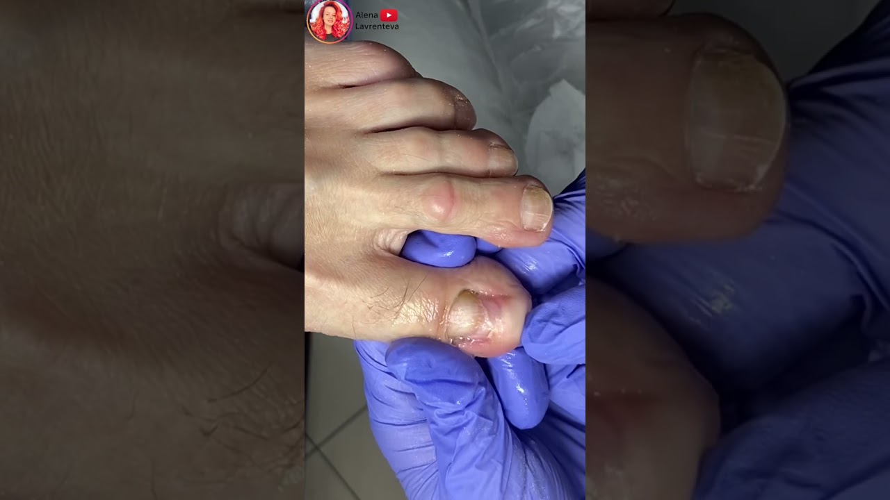 Онихолизис ногтей на ногах - YouTube