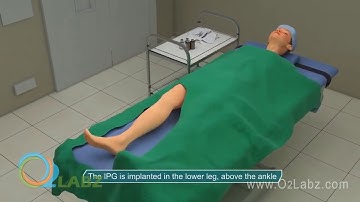Nuvient Wireless Neurostimulation System Animation
