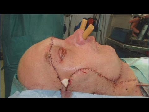 Βίντεο: Για πρώτη φορά, οι χειρουργοί κατάφεραν να πραγματοποιήσουν με επιτυχία μεταμόσχευση προσώπου και χεριού