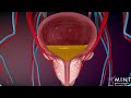 Prostate Artery Embolization PAE Video