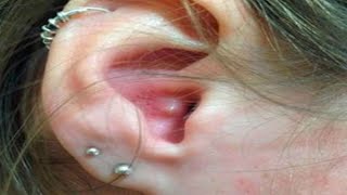 Home Remedies for painful pimples in ear