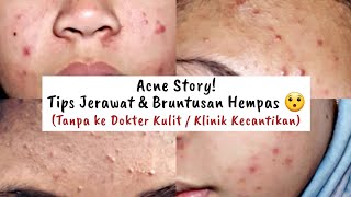 ACNE STORY   TIPS JERAWAT & BRUNTUSAN HEMPAS! 😯 | SHELAADAWIYAH