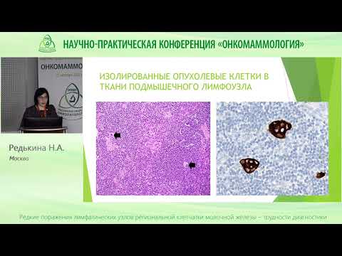 Редкие поражения лимфоузлов региональной клетчатки при раке молочной железы Трудности диагностики