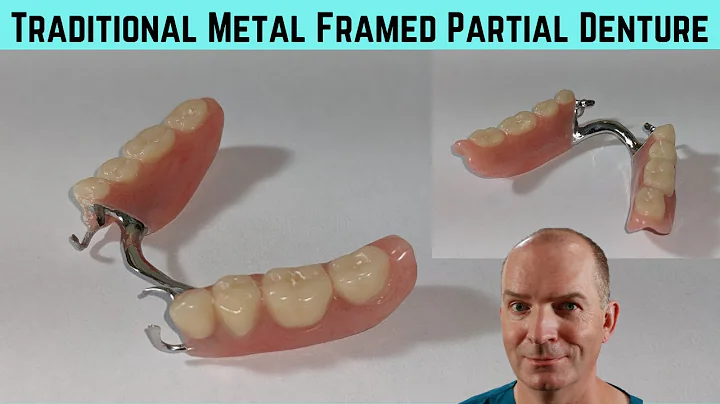 Close up look at a traditional metal framed partial denture