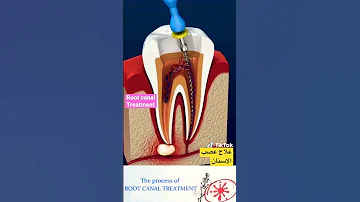 علاج عصب الاسنان في ثواني Dental Root Canal Treatment 