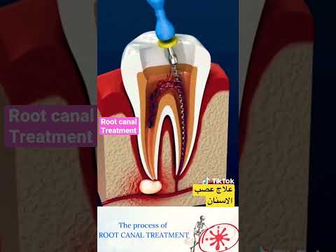 فيديو: 3 طرق سهلة لعلاج جذر الأسنان المكشوف
