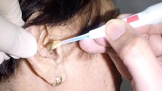 Elderly Woman's Earwax Removed with Lighted Ear Curette by Earwax Specialist 22,551 views 4 months ago 1 minute, 56 seconds