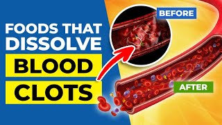 TOP 7 FOODS that Dissolve BLOOD CLOTS by Heart Disease Code 118,552 views 1 month ago 16 minutes