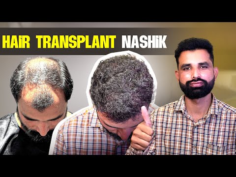 Natural-Looking Results: Best Hair Transplant Clinic in Nashik 😍 | New Roots Hair Transplant