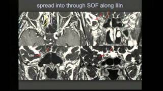 Imaging as a Prognostic Tool – Advances in Ultra High Resolution MR for Tumor Targeting and Mapping