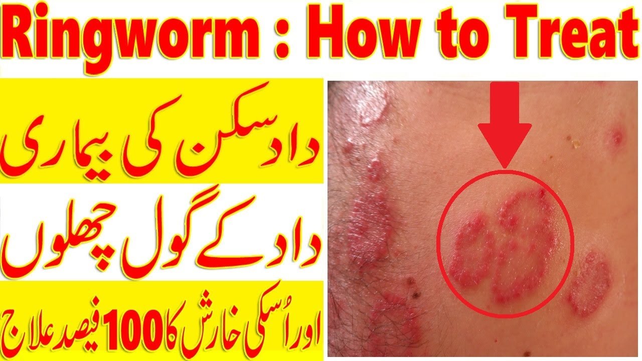 Daad Skin Problem Ringworm Treatment At Home | Skin Problem itching Rash Allergy | Daad ...