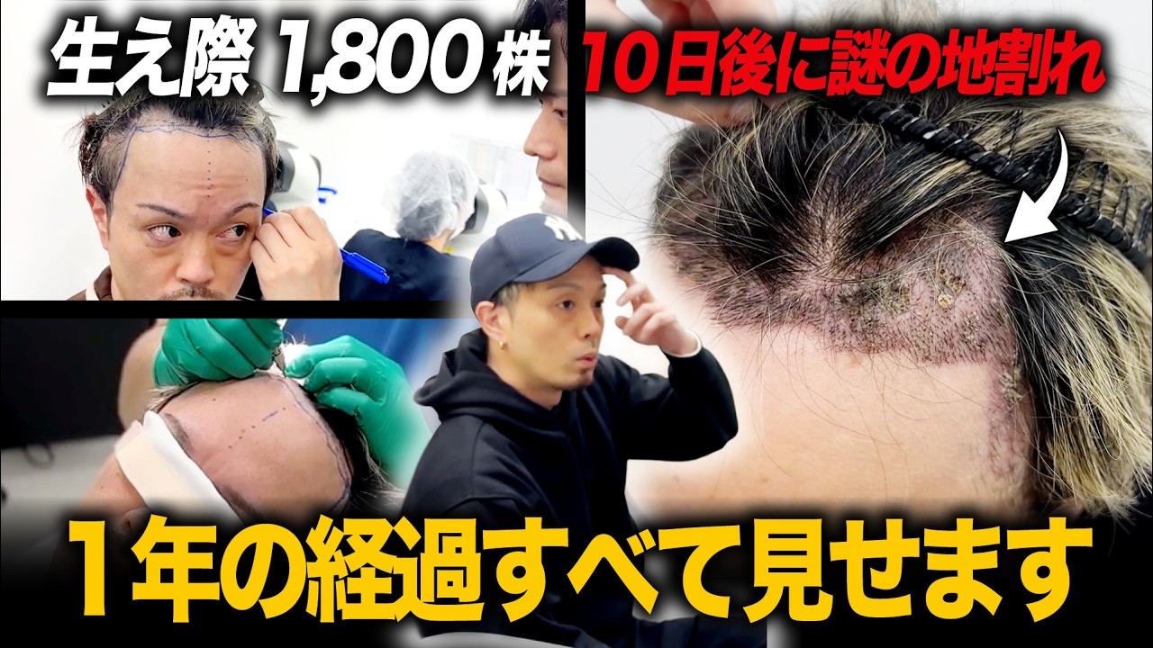 Hair Transplant] Is this progress normal? The full journey from