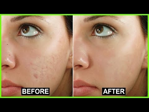 How to Get Rid of Blemishes on Face | Best Acne Scar Treatment.