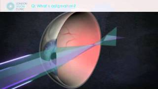 What is astigmatism?