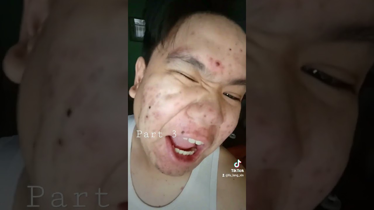 26th Vlog 8 Days Journey Chicken Pox 🥲😭Part 3 