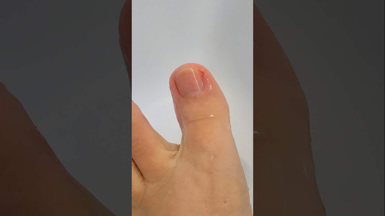 Pedicure Mistake — What Happens with Sharp Tools?