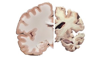 Alzheimer