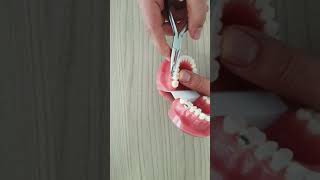 Ortodontik Tedavide Tel Batması Ortodontik Tedavide Tel Batması