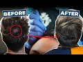 Getting my Scalp Microbladed to Hide Balding | Hair Thinning Solution