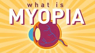 myopia újszülöttekben látás 0 7 mindkettőn