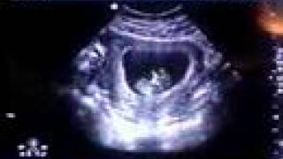 Baby's 1st Ultrasound