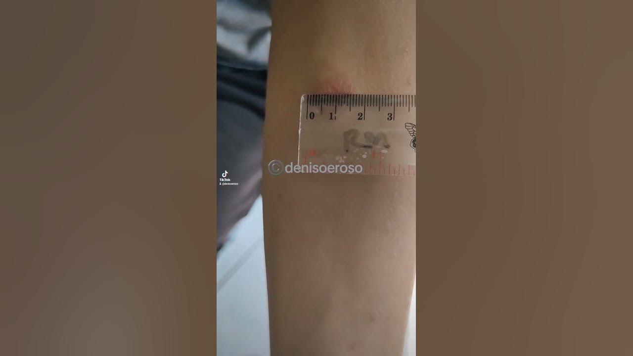 mantoux-test-positive-lebih-dari-10mm-youtube