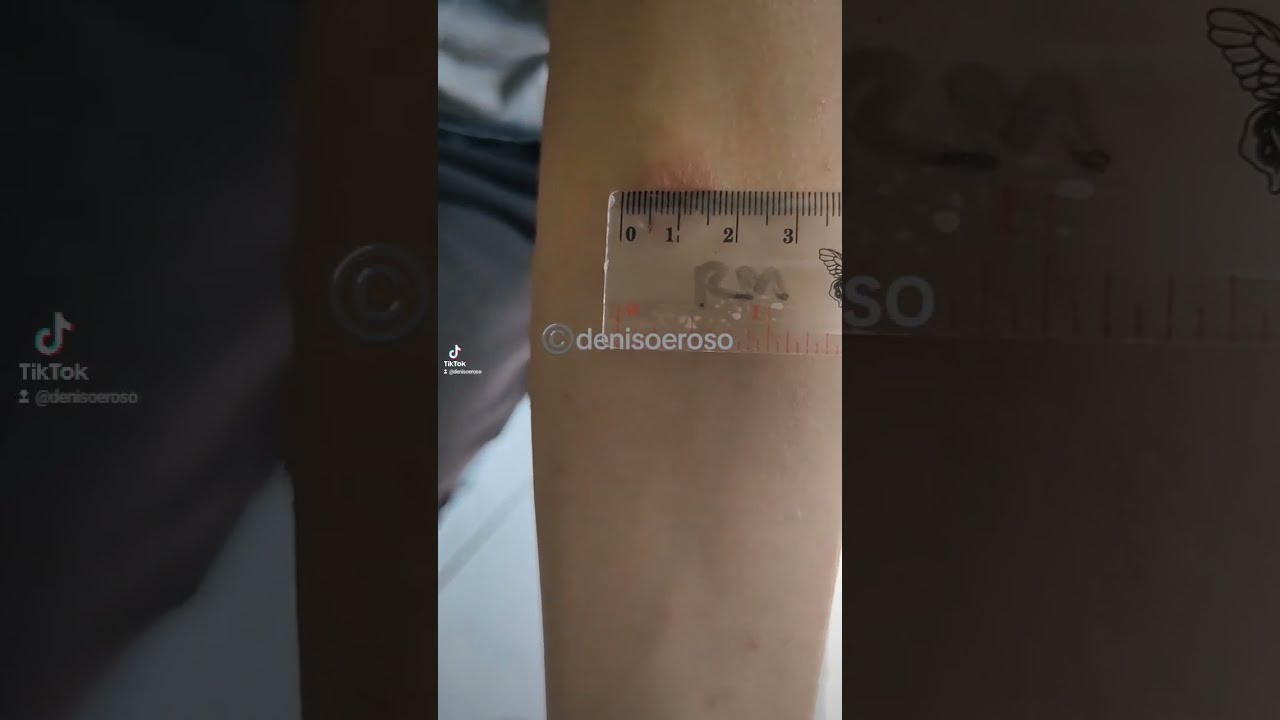 Mantoux Test Positive Lebih Dari 10mm YouTube Mantoux Test Positive Lebih Dari 10mm YouTube
