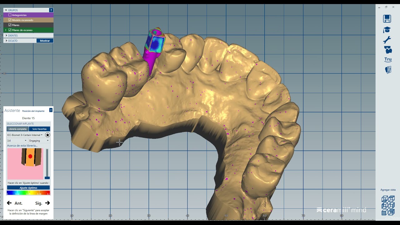 Diseño corona sobre Implantes con Exocad
