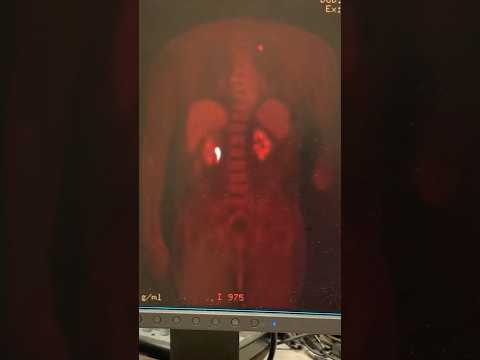 Video What does a PET scan show? GE PET Scanner #radiology... - youtube