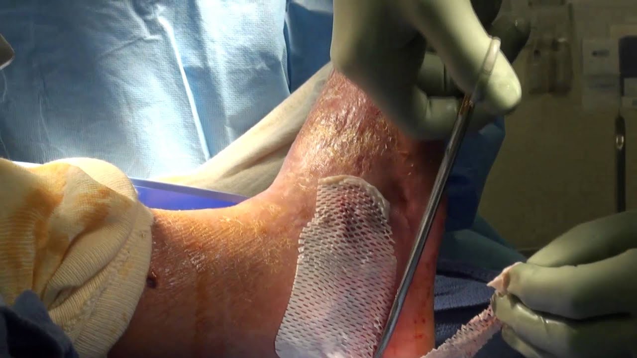 Wound Repair Vol 2 - YouTube