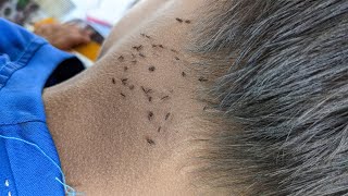 How to remove all hundred lice from short hair - Take out all of big lice from head