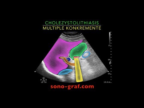 003 - Sonografie - Cholezystolithiasis