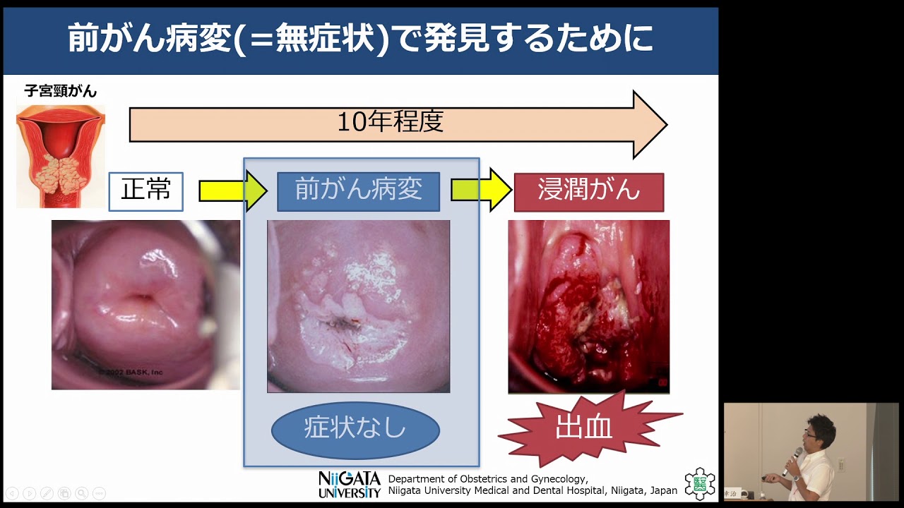 子宮頸がん症状