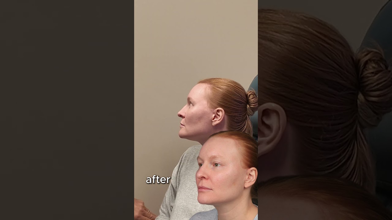 MicroLift Plus: When Extra Skin Removal Makes All the Difference