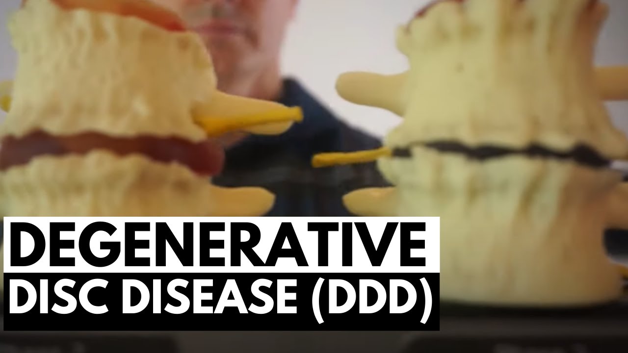 What Can You Do To Help Degenerative Disc Disease (DDD)? - Chiropractic on  Eagle, Dr. Jon Saunders