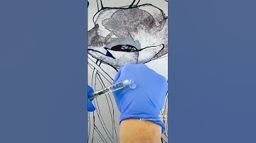 What does one syringe of filler look like