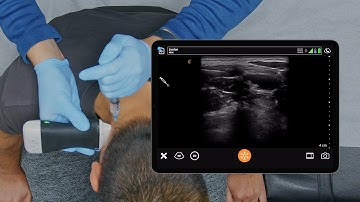 USG Greater Occipital Nerve Block