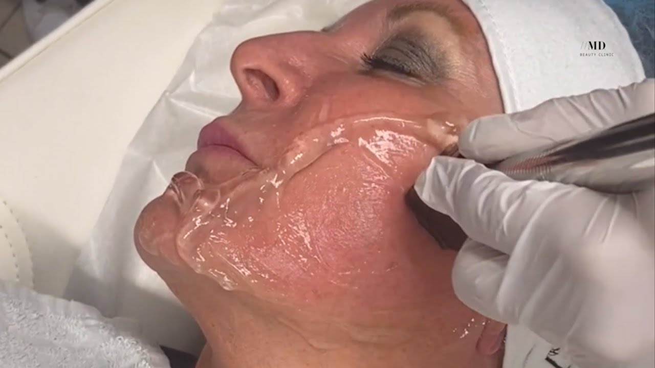 Forma Facial Skin Tightening at MD Beauty Clinic