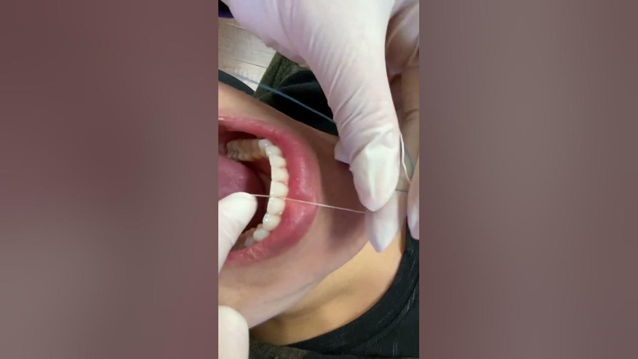 How to floss with your glued in bottom retainer (English) YouTube