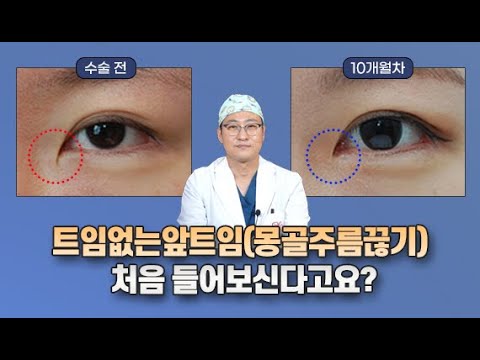 몽고주름 끊어내기 | 압구정김원장