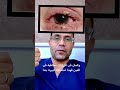 الرمد الربيعي _ اعراض الرمد الربيعي